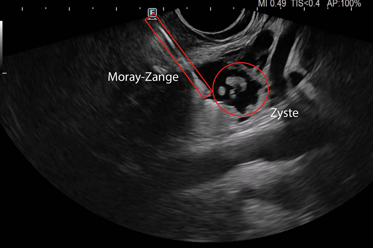 Im Ultraschall erkennt der behandelnde Arzt die Zyste und kann mithilfe der Moray-Zange eine gezielte Probe entnehmen. Foto: DRK-Krankenhaus